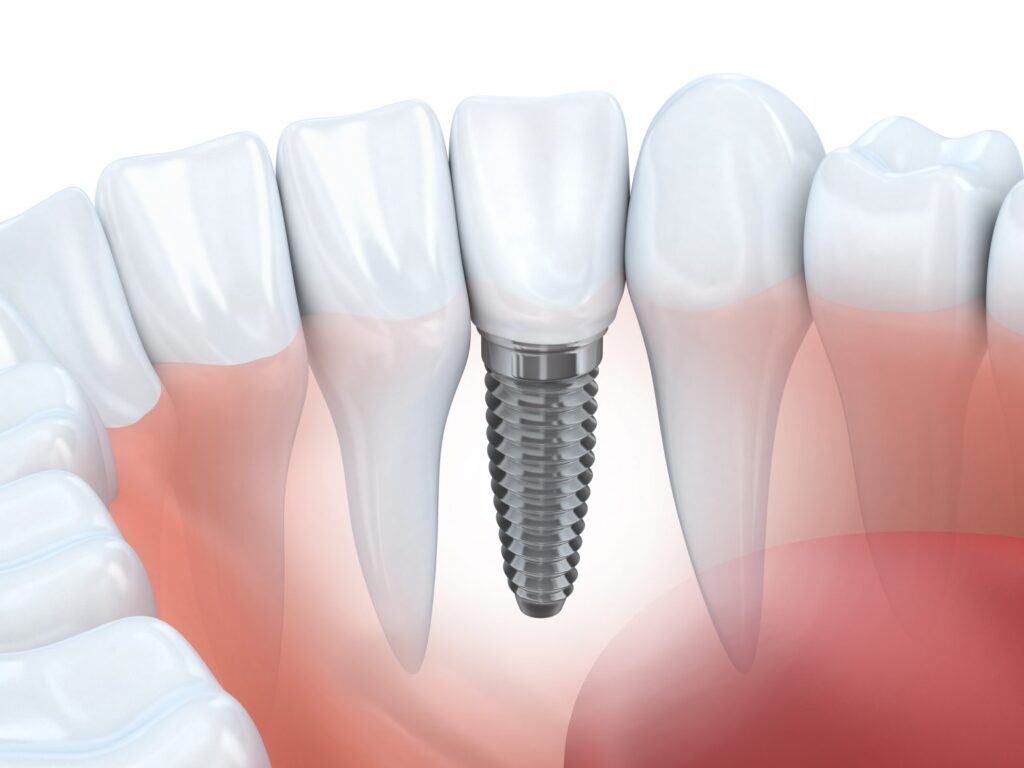 The Many Benefits Of Dental Implants