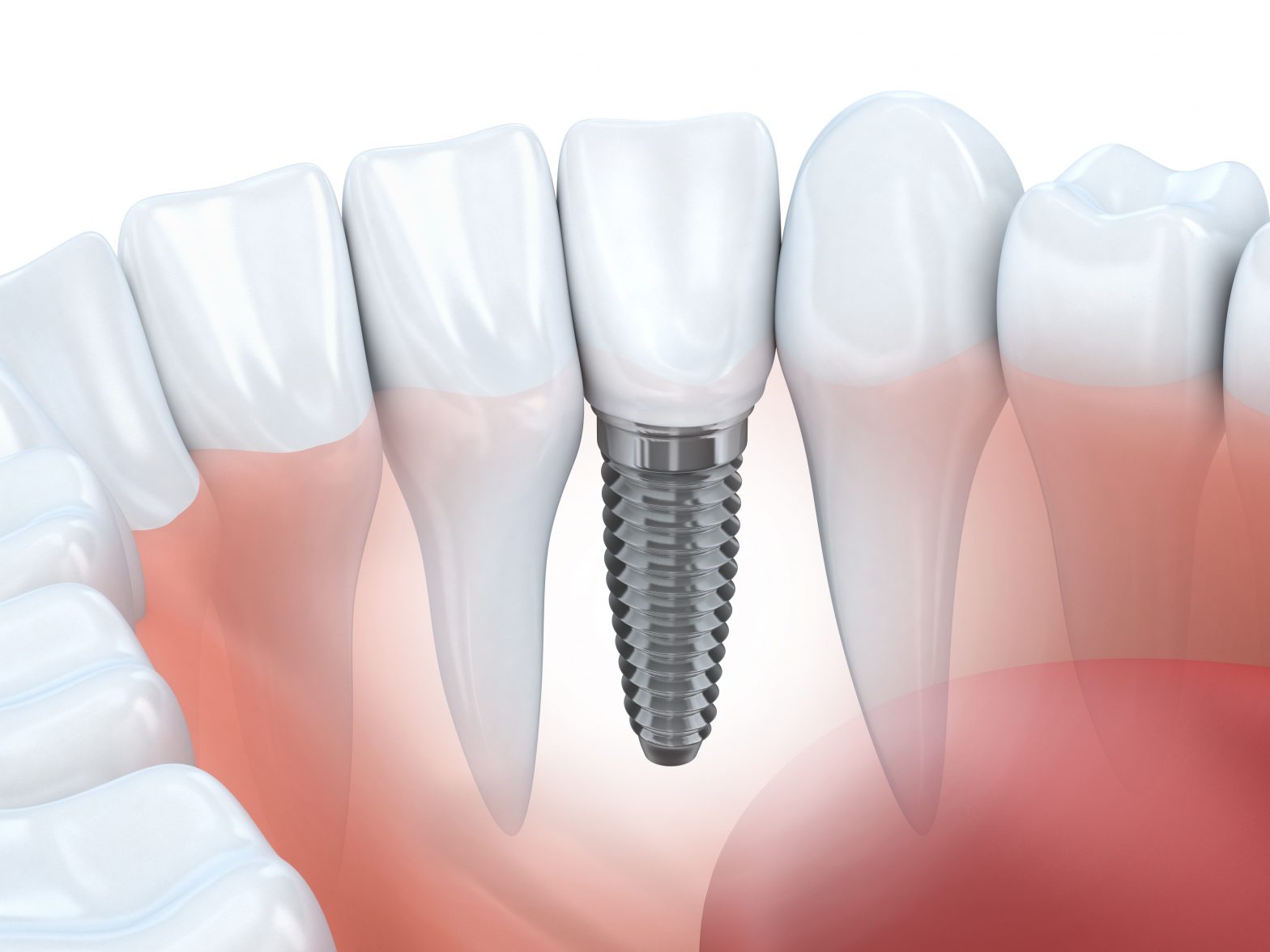 The Many Benefits Of Dental Implants