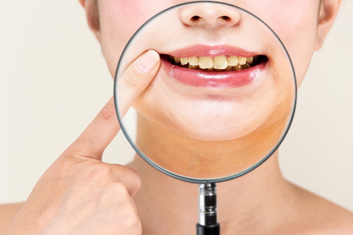 San Diego, Ca Dentist Provides Methods For Whitening Discolored Teeth
