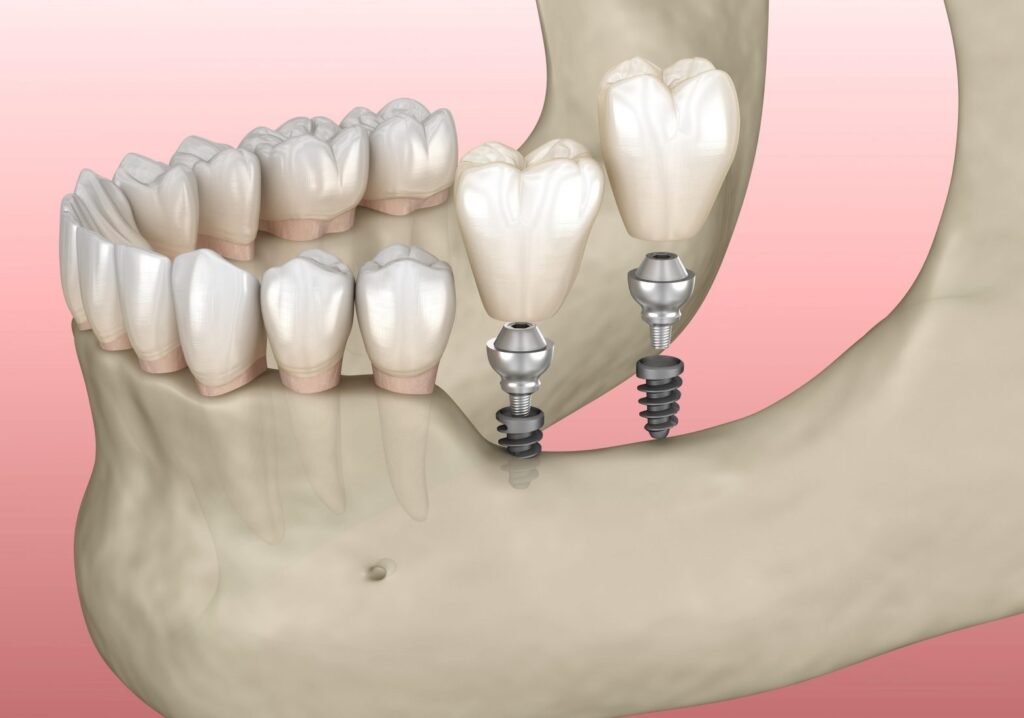 everything about mini dental implants