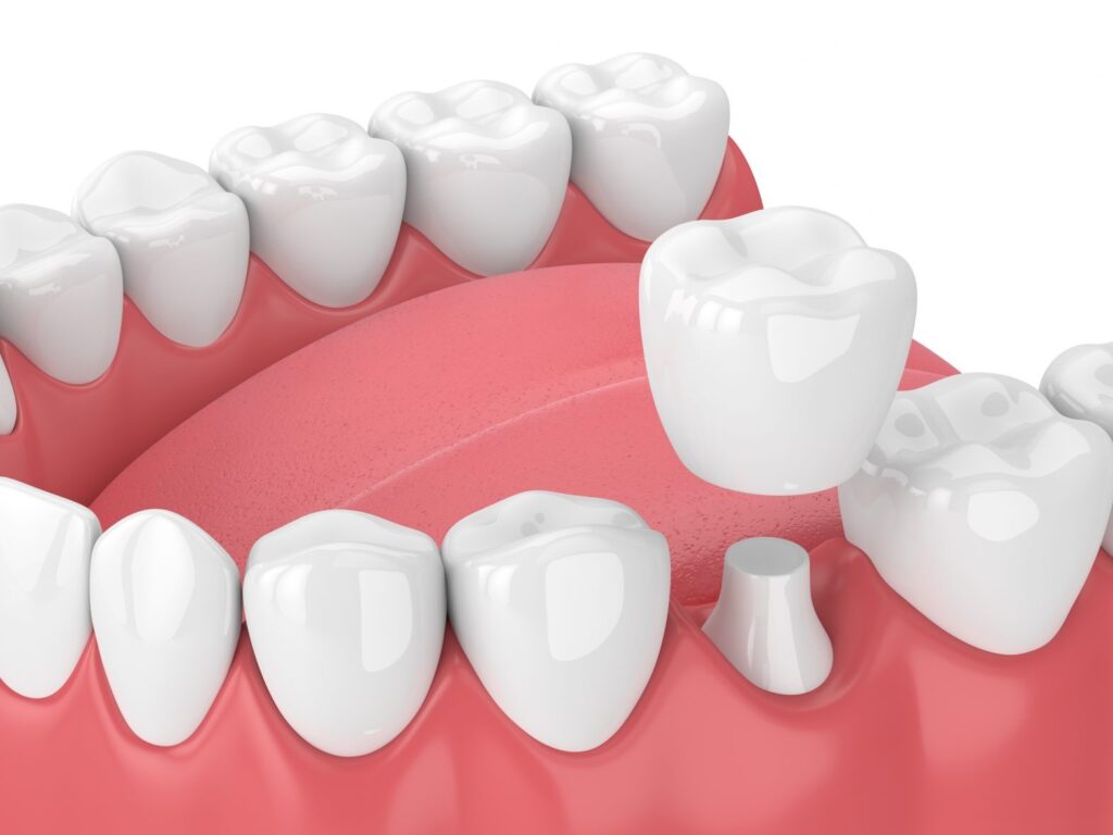 different types of dental crowns which one is right for you