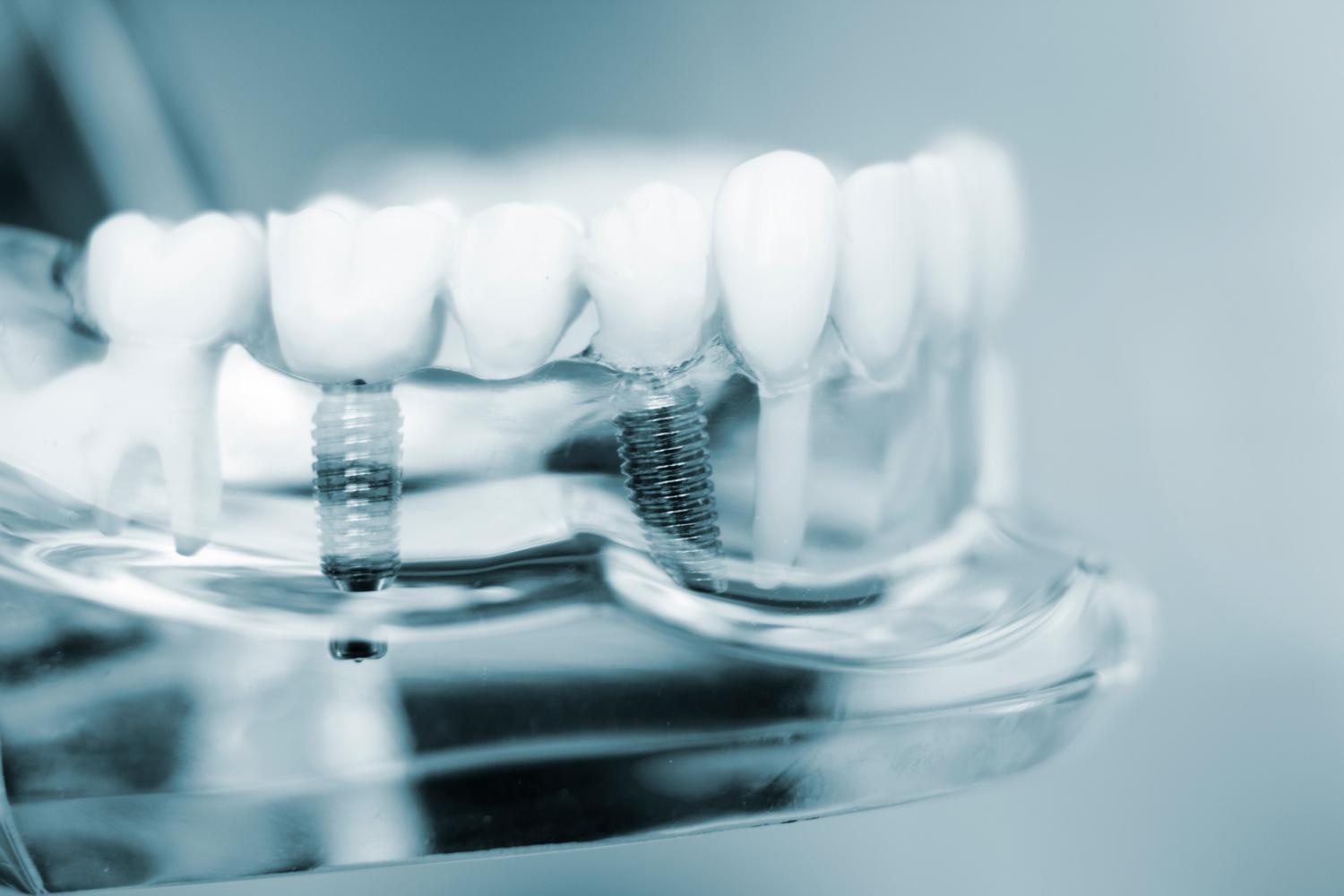 implant care and maintenance
