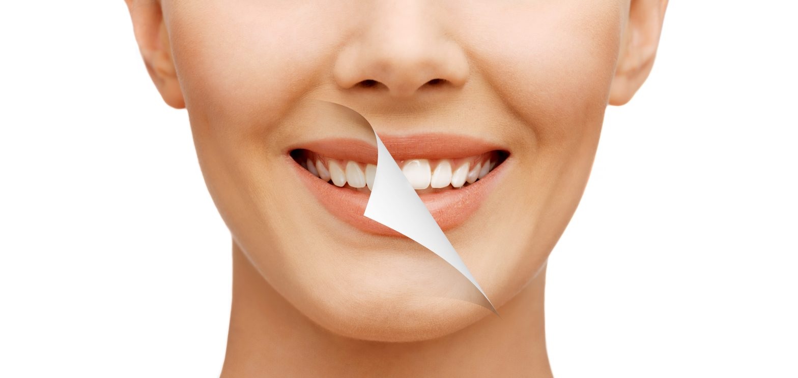 differences between in office and at home whitening treatments