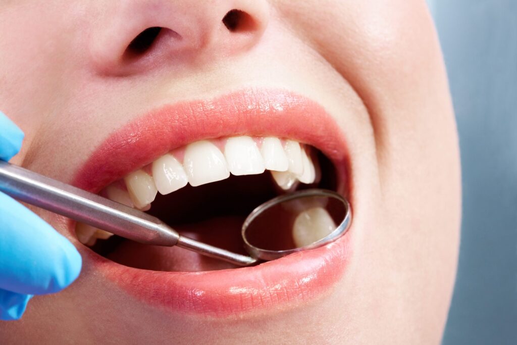 Dental Fillings Mira Mesa