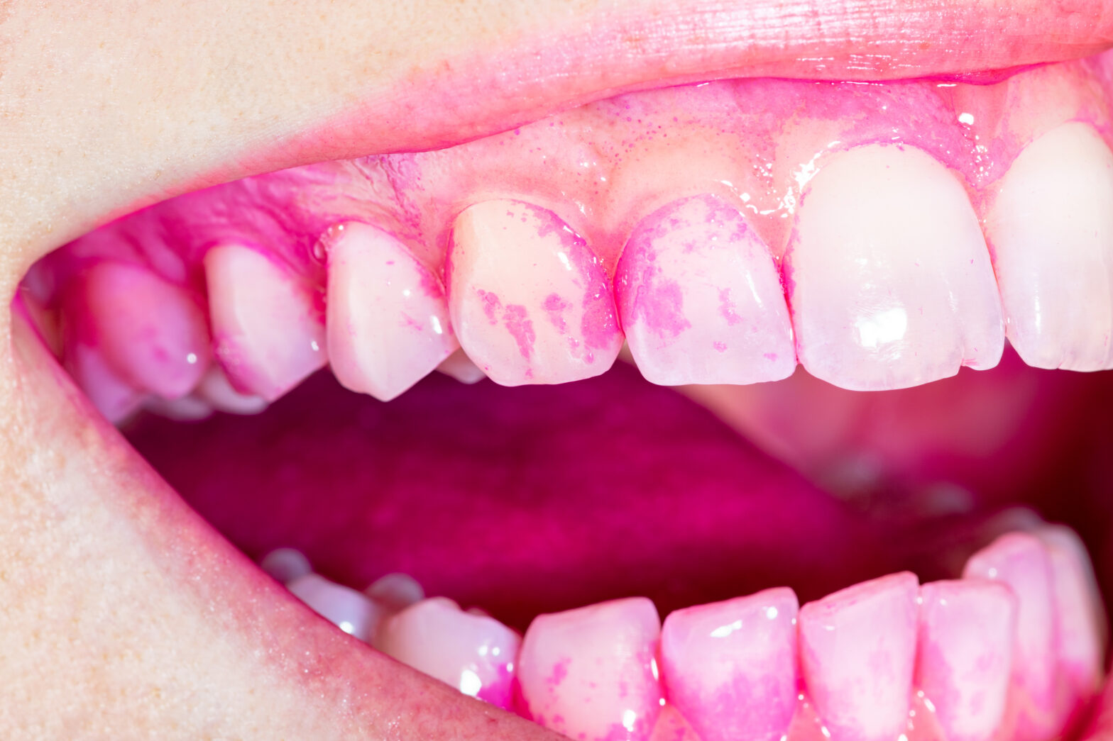 How Long Does It Take for Gums to Heal After Deep Cleaning?