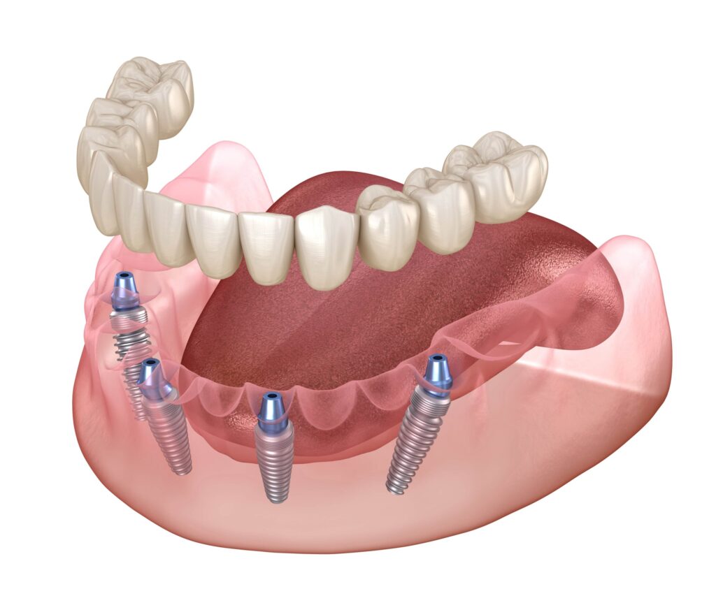Dental Implants vs. Dentures: Which Option is Best?