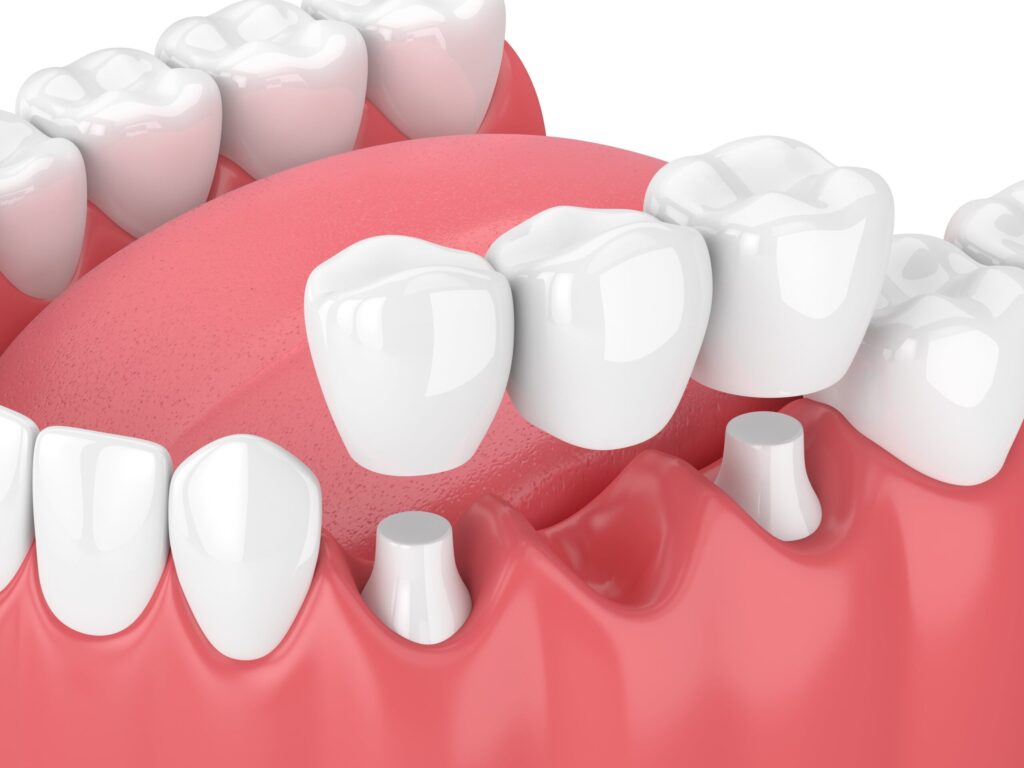 How Do Dental Bridges Work: What You Need to Know
