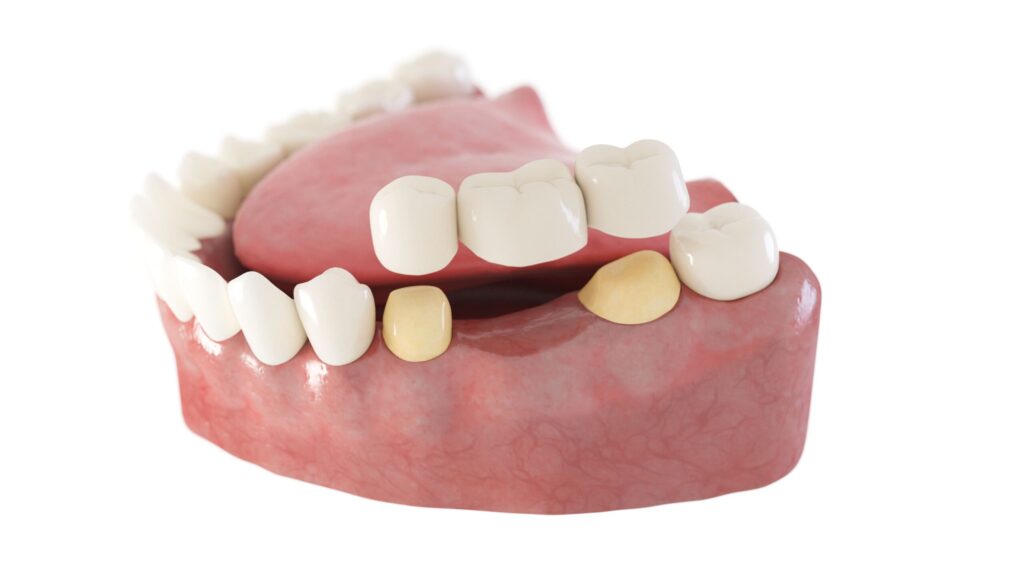 Dental Bridge Aftercare: Tips for a Smooth Recovery