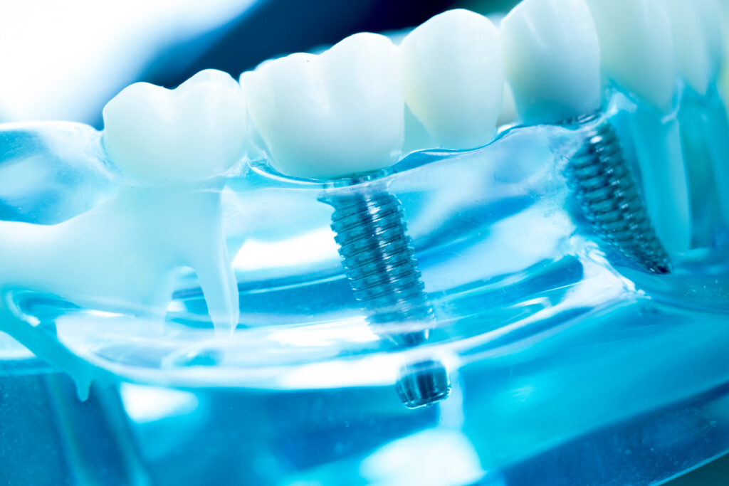 Dental Implants vs. Traditional Solutions in Mira Mesa
