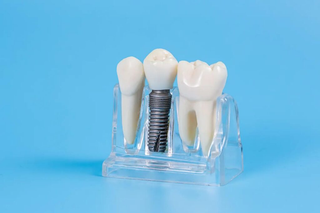 dental implants cost mira mesa san diego